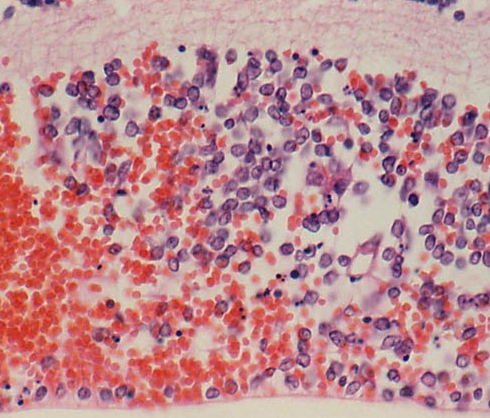 abetalipoproteinemia