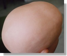 alopecia total