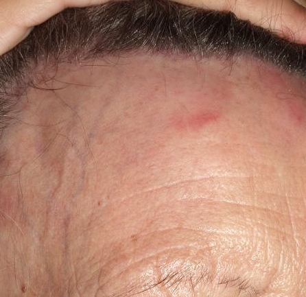 alopecia frontal