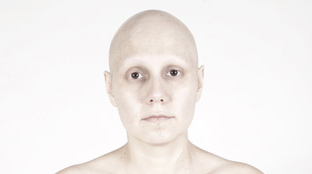 alopecia universal