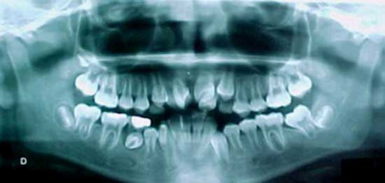 dentinogenosis imperfecta tipo 3