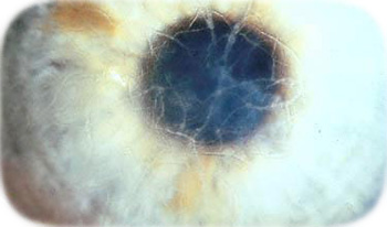 distrofia corneal
