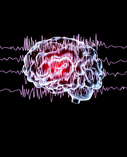 Epilepsia generalizada - discinesia paroxística