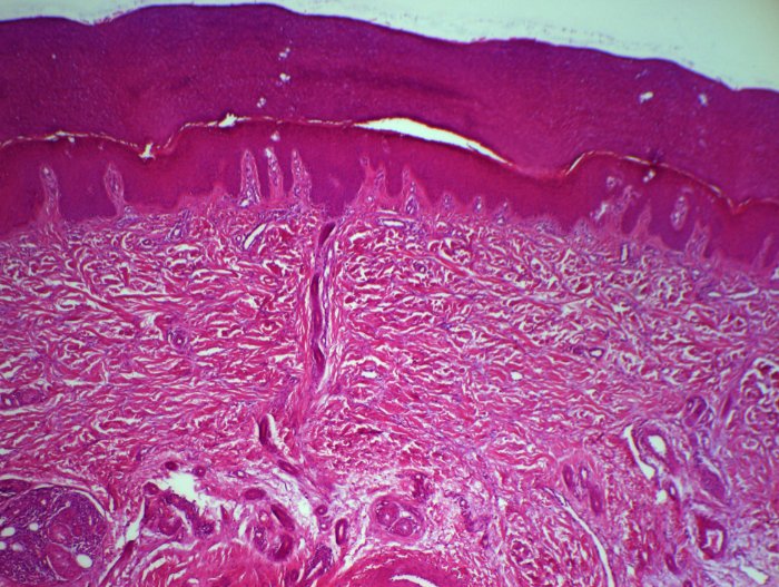 fibromatosis hialina