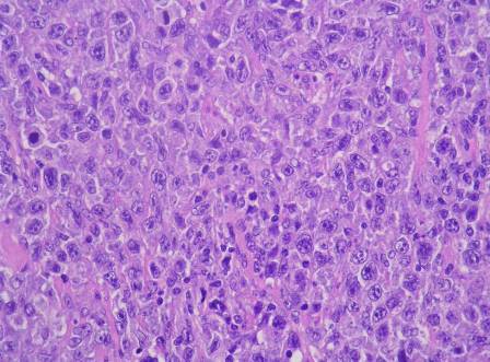 linfoma de células B grandes, perfil molecular