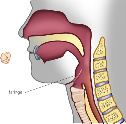 miopatía distal con debilidad faríngea y de las cuerdas vocales