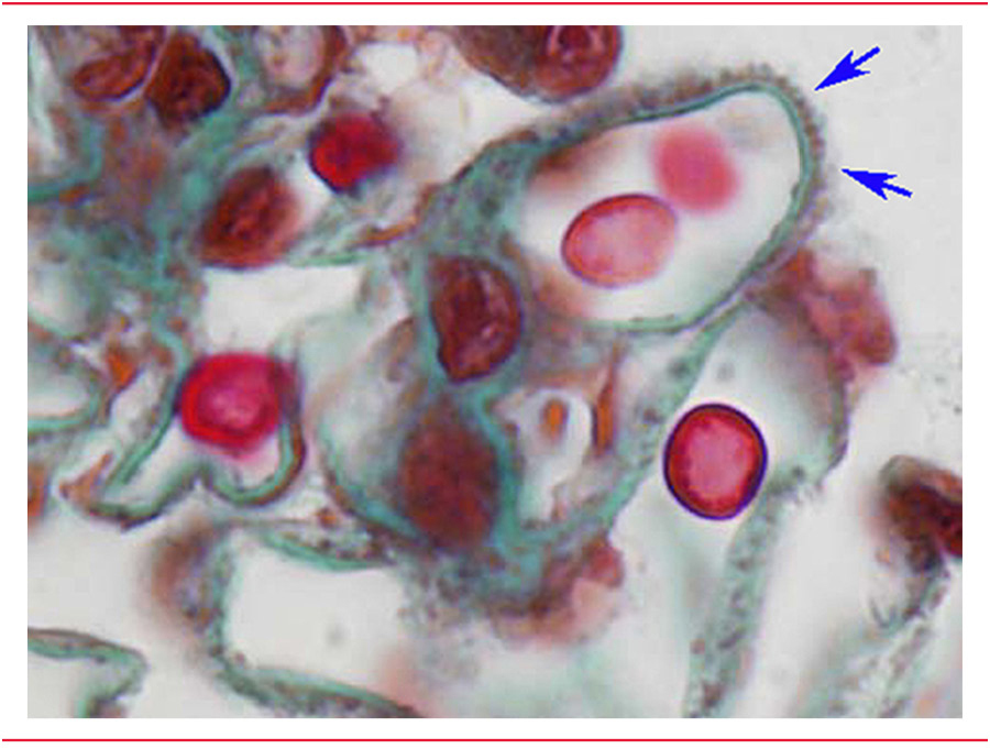 nefropatía membranosa congénita