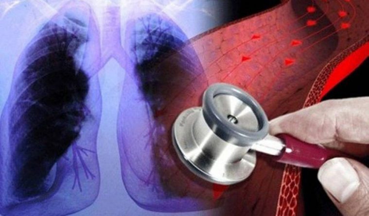 Por eso odio hipertensión endocraneana benigna
