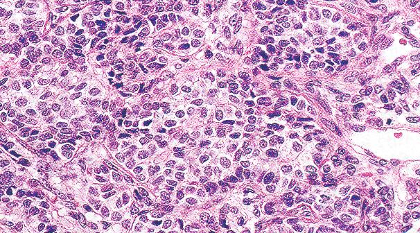 Tumor ovárico maligno de células de la granulosa