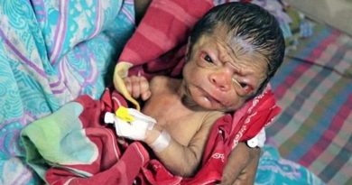 Nace en Bangladesh un bebé con cara de anciano y abundante pelo en la espalda Nace en Bangladesh un bebé con cara de anciano y abundante pelo en la espalda