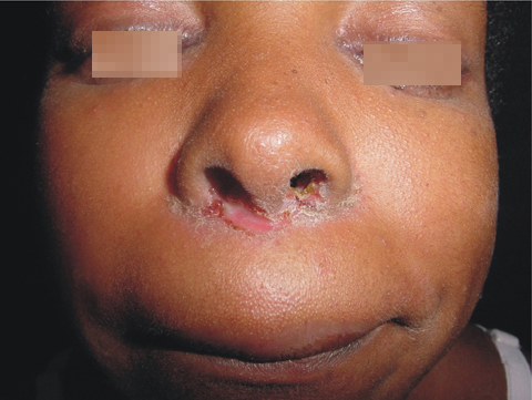 Dermatitis infecciosa asociada al HTLV-1