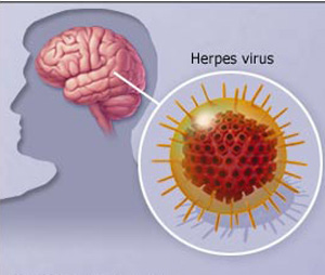 Encefalitis por herpes simple