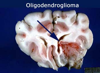 Tumor oligodendroglial