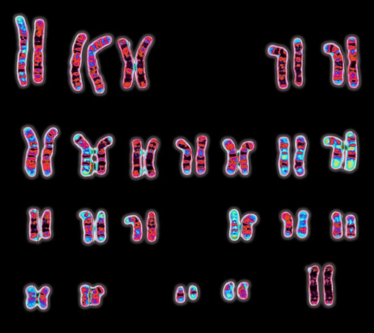 La inactivación deficiente del cromosoma X podría explicar las diferencias en la frecuencia del lupus eritematoso entre mujeres y hombres