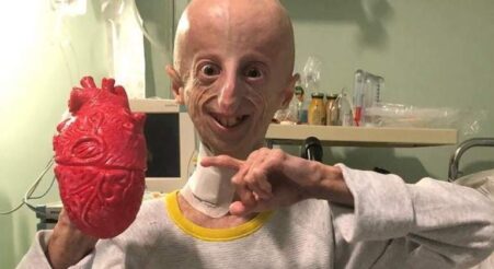 ammy Basso, biólogo y enfermo de progeria. Foto: Instagram de Basso