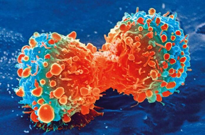 Células inmunitarias promotoras de tumores capacitadas para combatir el tipo de cáncer cerebral más agresivo