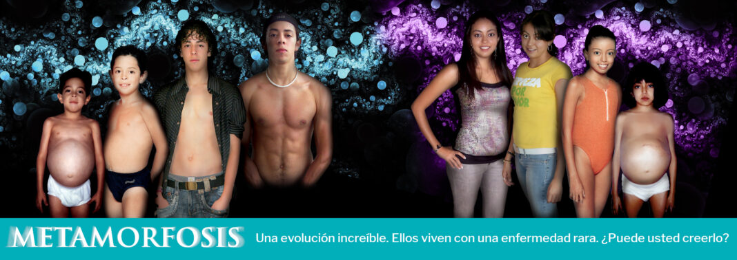 Metamorfosis de personas que viven con una enfermedad rara. Una evolución sorprendente. ¿Puede usted creerlo? Si ellos pudieron, ¿por qué otros no?