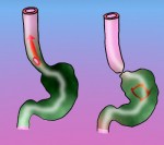 acalasia-esofagica