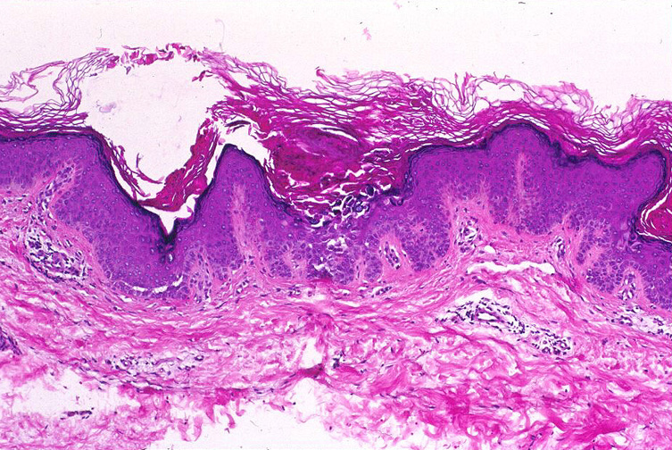 dermatosis