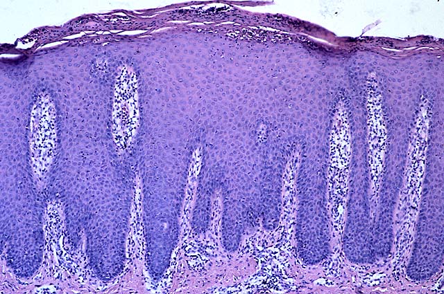 lesiones psoriasiformes