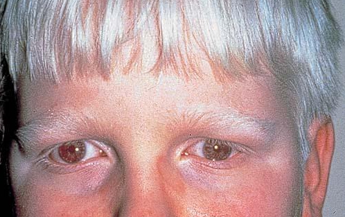 albinismo oculo