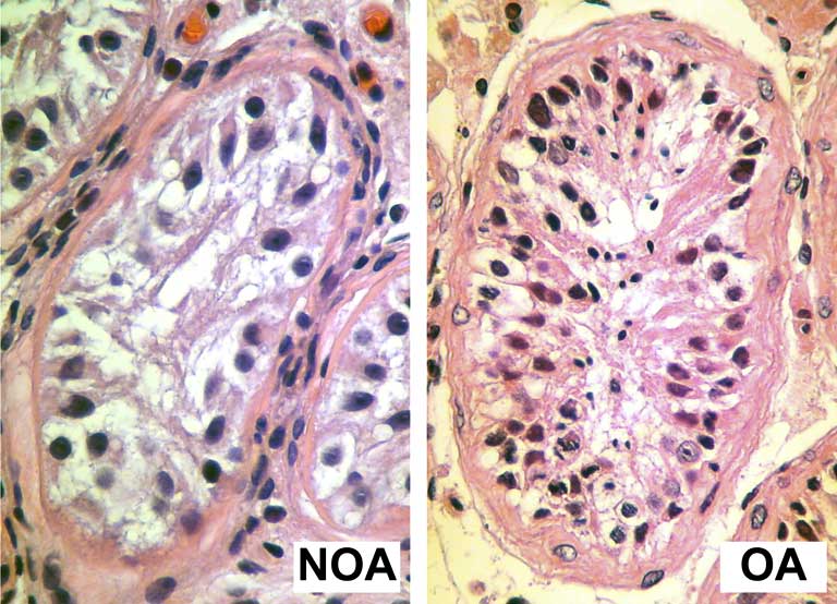 azoospermia