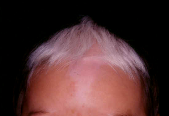 albinismo cabello negro y blanco