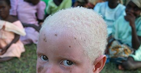 albinisno ocular tipo 2