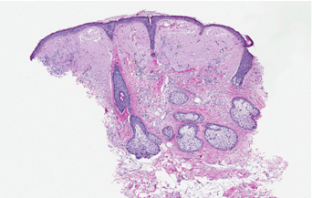 amiloidosis nodular cutanea
