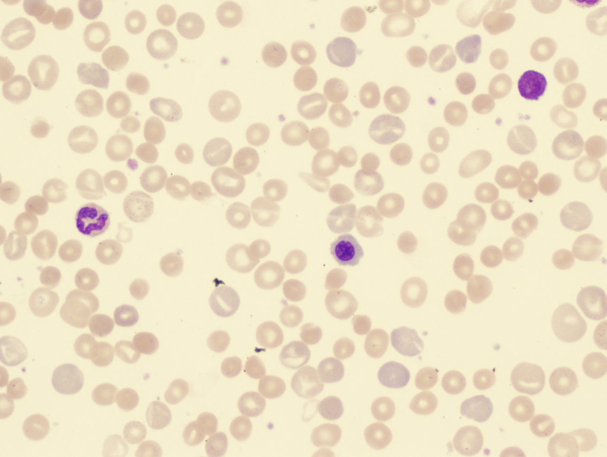 anemia hemotílica autoinmune