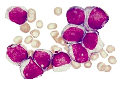 anemia mieloide