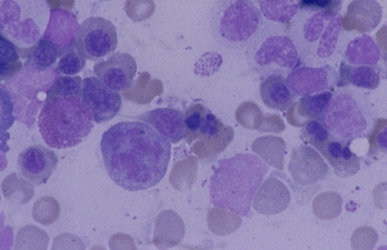 anemia sideroblastica