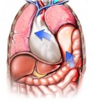 hernia-torax