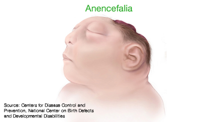anencefalia