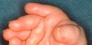 desviacion-ulnar-caracteristica-sindrome-sheldon-hall-o-distal-artrogriposis-tipo-2B