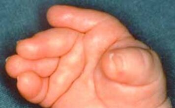 desviacion-ulnar-caracteristica-sindrome-sheldon-hall-o-distal-artrogriposis-tipo-2B
