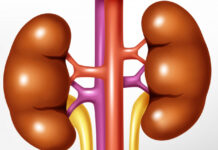 Hiperplasia suprarrenal congénita por deficiencia de 17-alfa-hidroxilasa