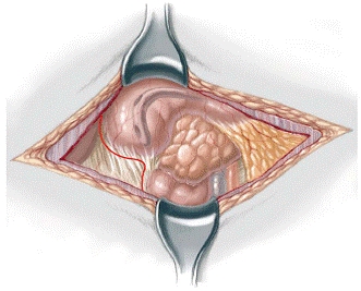 atresia intestinal multiple