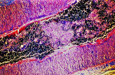 atrofoderma lineal de moulin