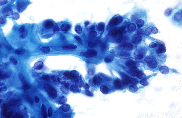 carcinoma neuroendocrino