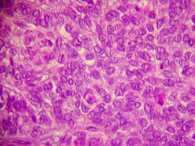carcinoma peritoneal