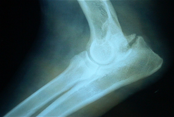 femur