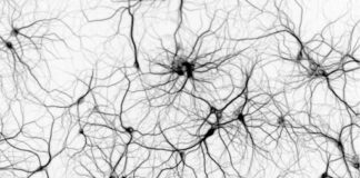 Déficit de la proteína de unión E3 de la piruvato deshidrogenasa