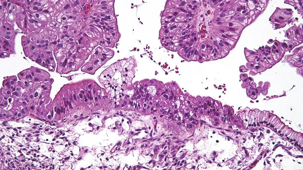 carcinoma peritoneal