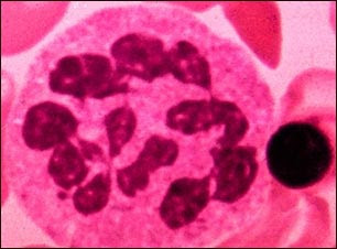 anemia megaloblastica