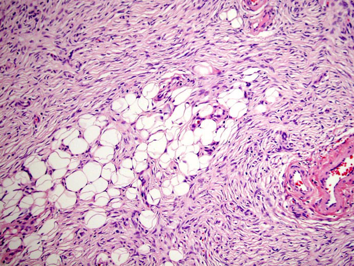 dermatofibrosarcoma protuberante