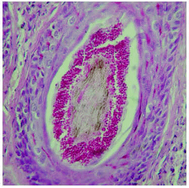 dermatosis pustulosa