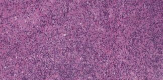 Esta página web de FEMEXER NO persigue ningún fin monetario de lucro. Solo se utiliza con fines informativos para la población mexicana. Imagen tomada del enlace https://www.mypathologyreport.ca/es/diagnosis-library/ebv-positive-diffuse-large-b-cell-lymphoma/ y del enlace https://www.mypathologyreport.ca/wp-content/uploads/2023/09/EBV-positive-Diffuse-Large-B-cell-Lymphoma.jpg. Esta página web de FEMEXER NO persigue ningún fin monetario de lucro. Solo se utiliza con fines informativos para la población mexicana.