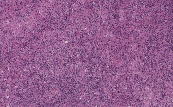 Esta página web de FEMEXER NO persigue ningún fin monetario de lucro. Solo se utiliza con fines informativos para la población mexicana. Imagen tomada del enlace https://www.mypathologyreport.ca/es/diagnosis-library/ebv-positive-diffuse-large-b-cell-lymphoma/ y del enlace https://www.mypathologyreport.ca/wp-content/uploads/2023/09/EBV-positive-Diffuse-Large-B-cell-Lymphoma.jpg. Esta página web de FEMEXER NO persigue ningún fin monetario de lucro. Solo se utiliza con fines informativos para la población mexicana.