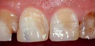 esmalte dental